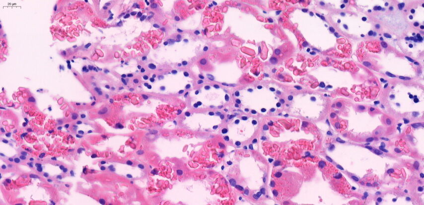 Secondary Toni-Debré-FANCONI syndrome – intracellular crystalline inclusions within proximal tubular epithelial cells