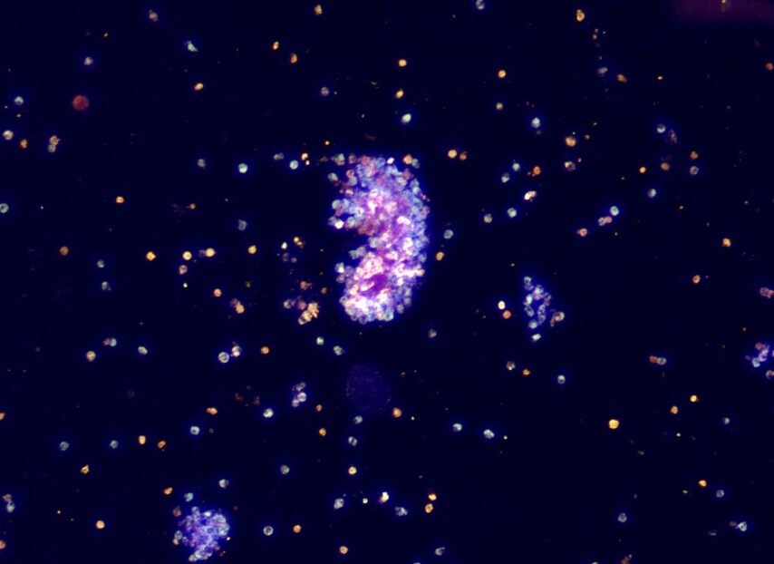 Bright field, dark field and phase contrast image of cluster of calcium oxalate dihydrate crystals surrounding leukocytes