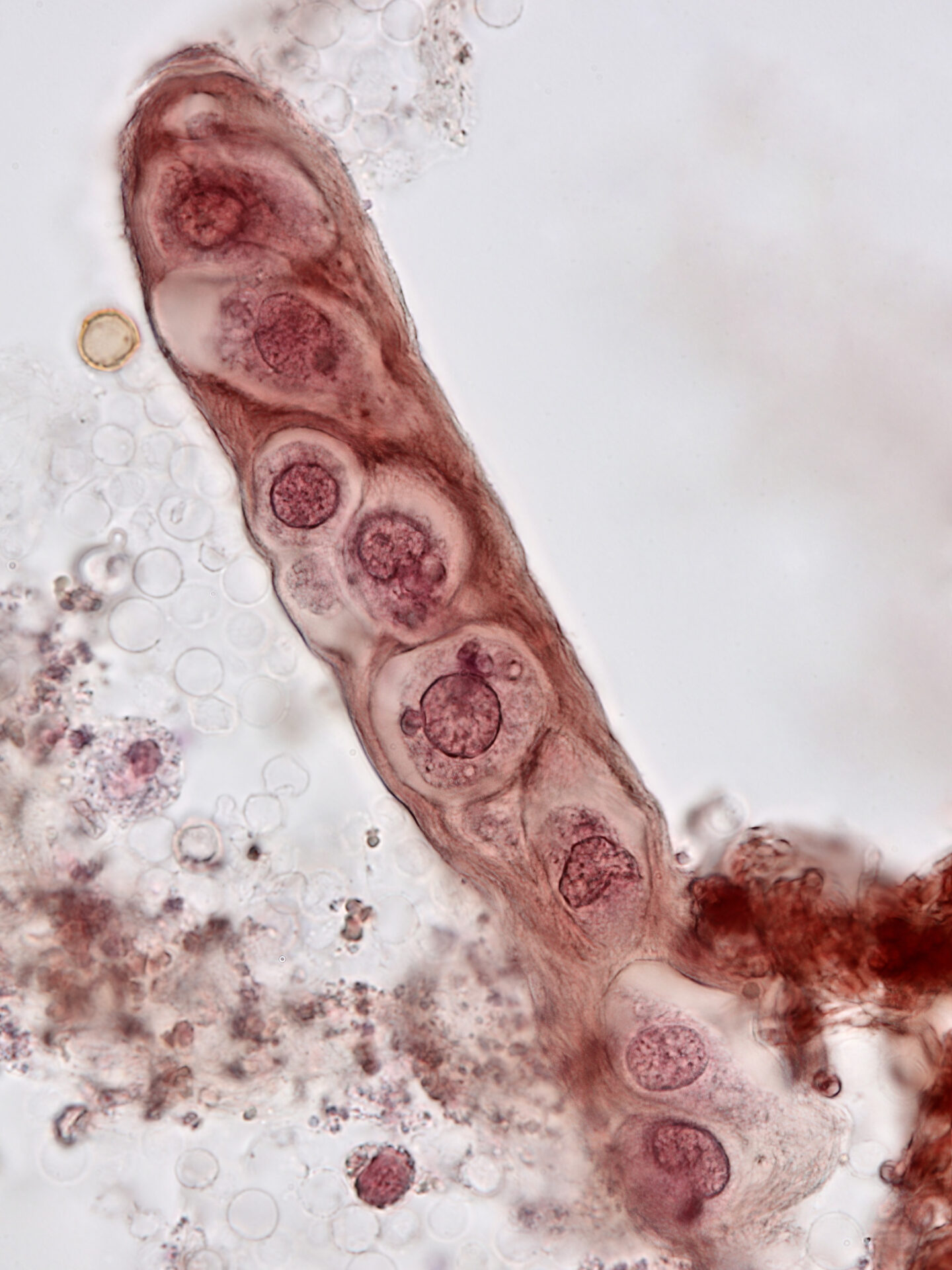 Renal tubular epithelial cell cast – brightfield with prolonged Sternheimer-Malbin staining