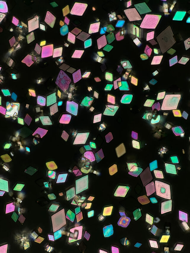 Uric acid crystals in urine, under fully polarized light