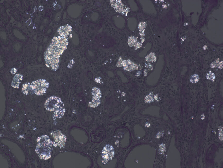 2,8-Dihydroxyadenine crystals in a rat kidney