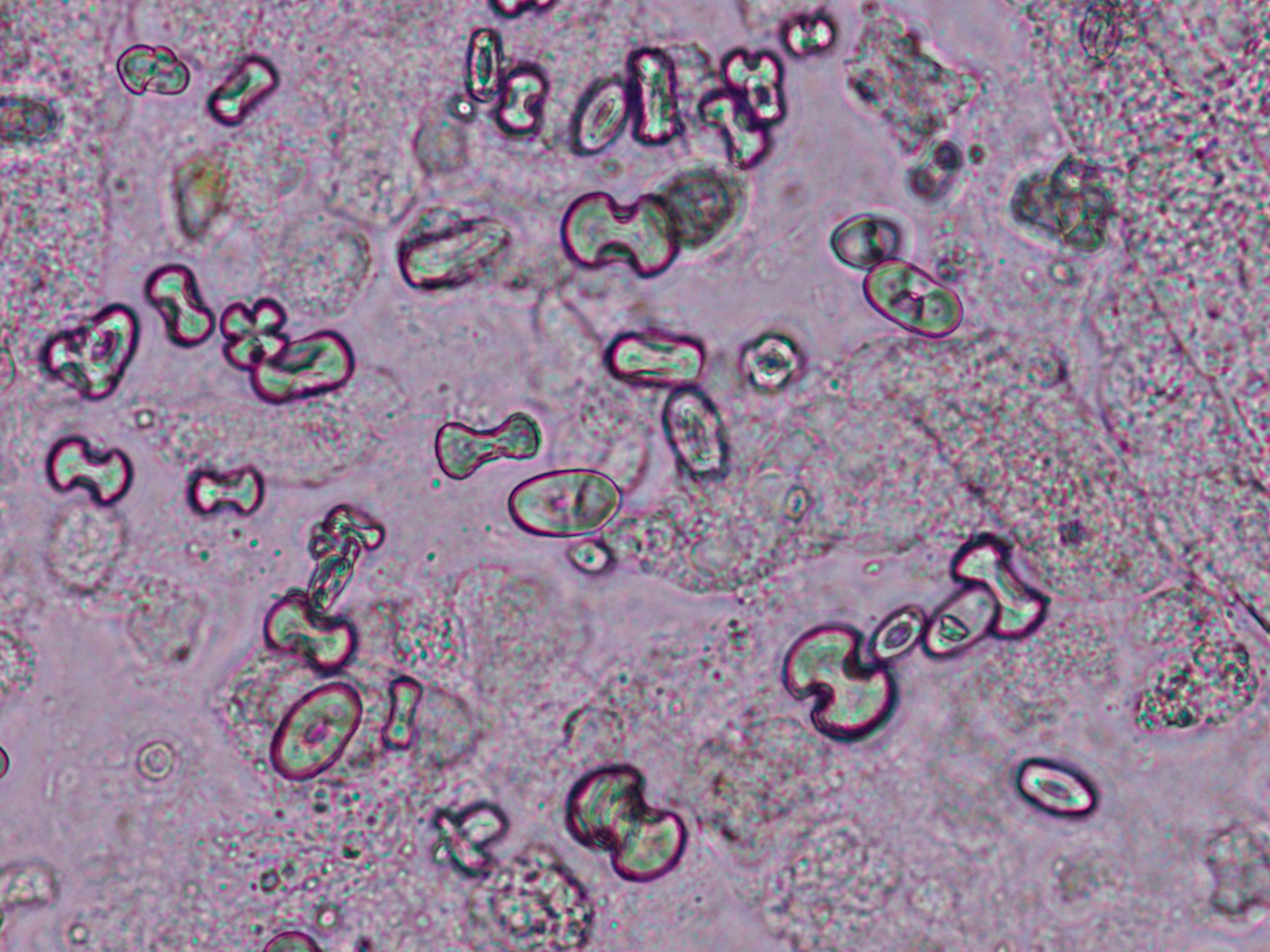 Calcium oxalate monohydrate crystals in a patient with acute kidney injury