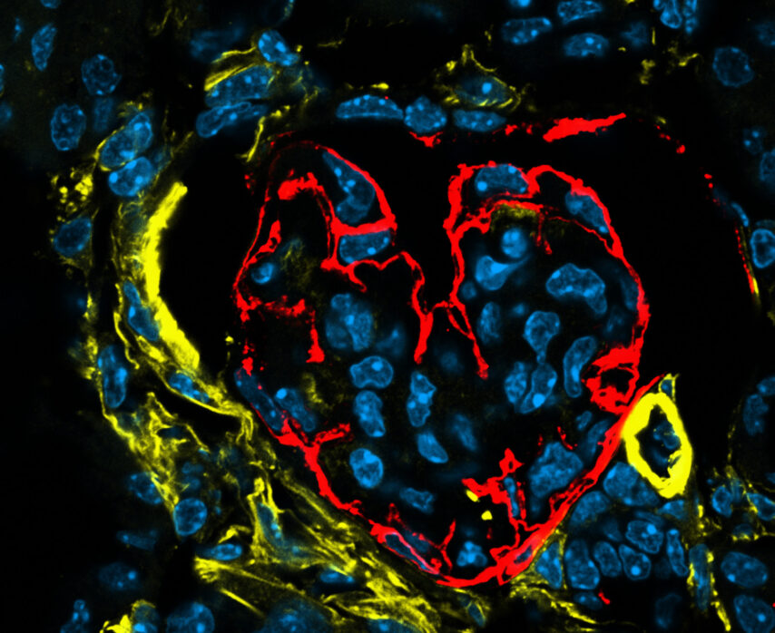 Love hurts – Heart-shaped glomerulus in a nephritic kidney